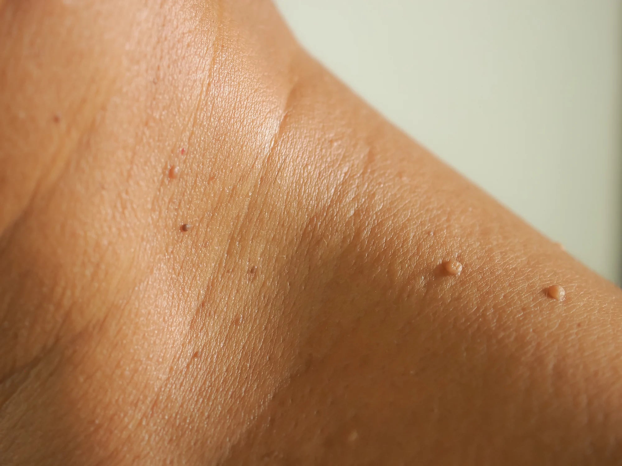 What Causes Skin Tags and How to Treat Them