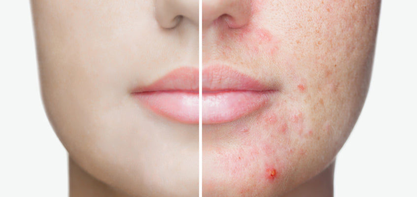 8 Questions Answered About Acne