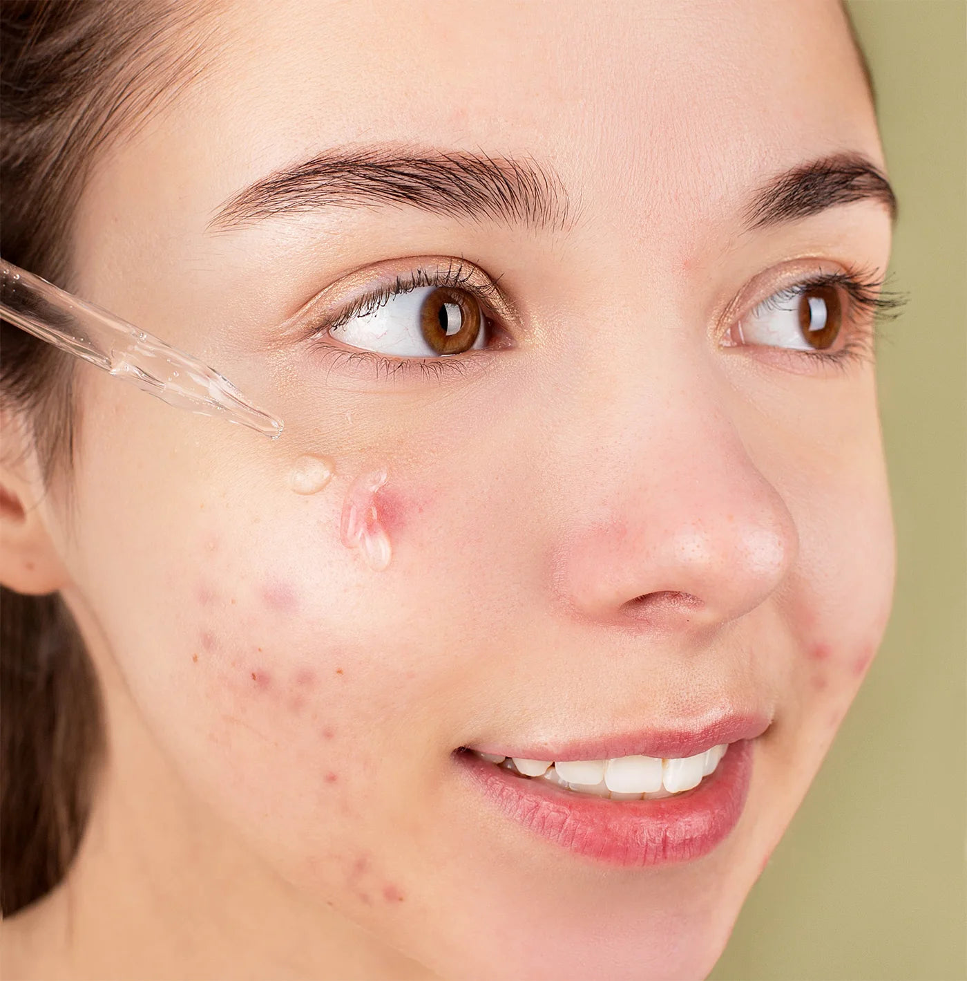 The 3 Best Skincare Ingredients To Banish Acne