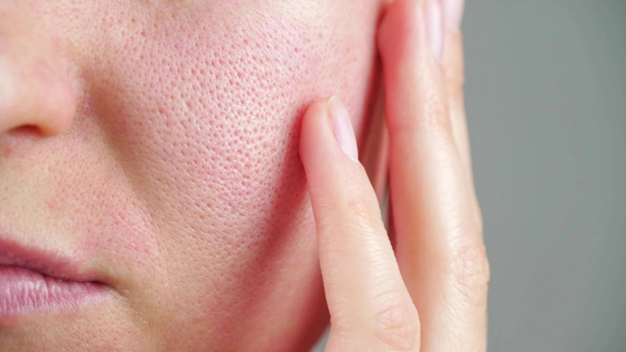 Can you shrink pores? Large Pores: why they happen and what you can do about them.